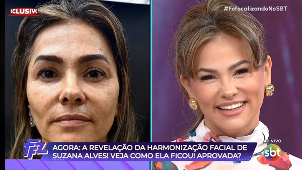 Ex-Tiazinha Suzana Alves faz harmonização facial: veja antes e depois