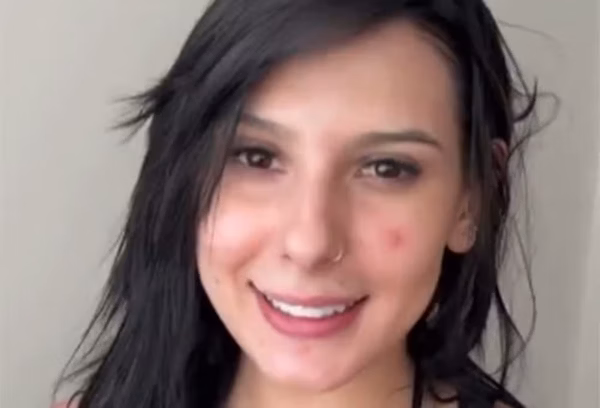 Ana Castela mostra rosto com acne e desabafa: “Bombinhas”