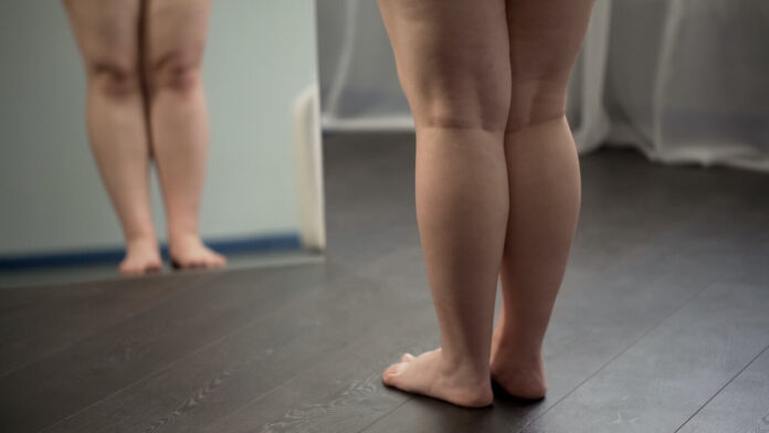 lipedema.jpg